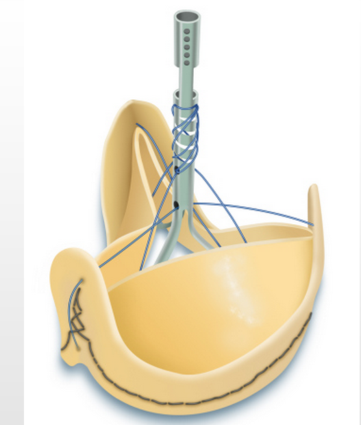 Sorin Group Announces FDA Approval of Solo Smart — the Next